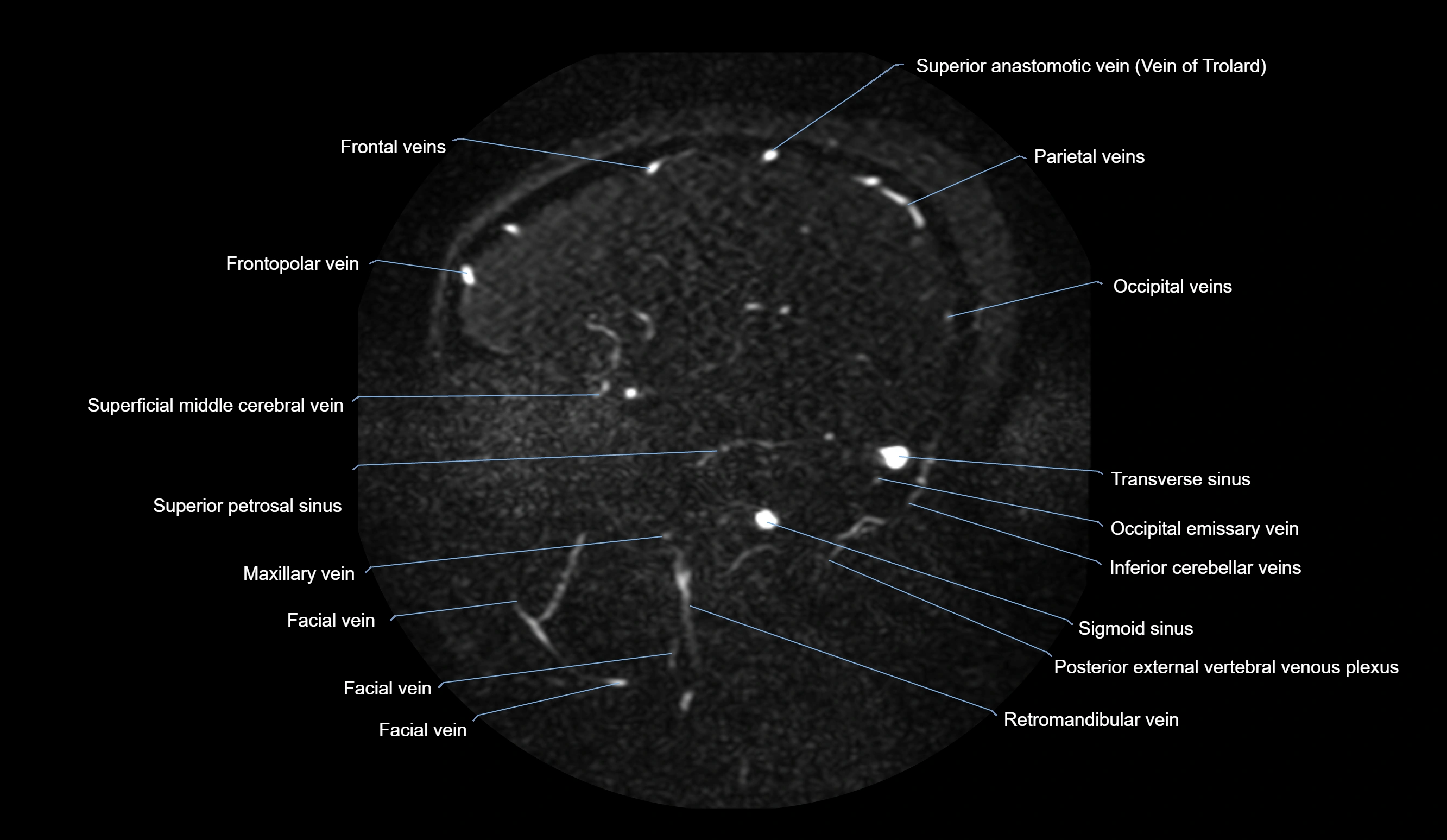 MRV brain sagittal anatomy 3T MRI images -img-01015-00061.webp